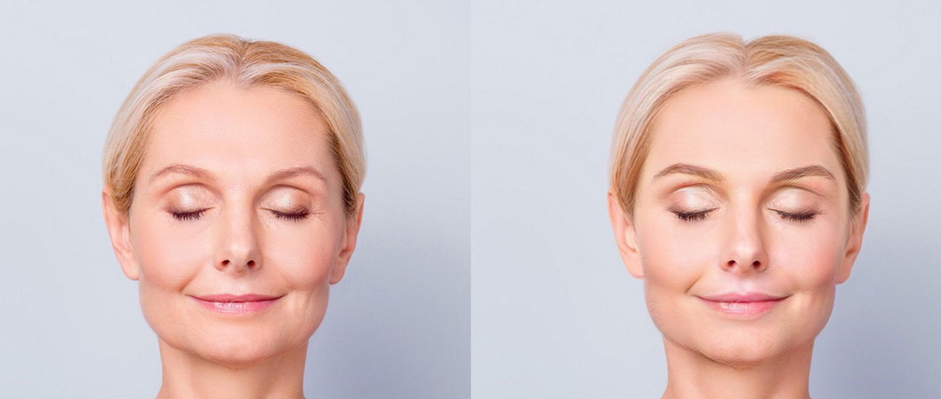 Лазерное фотоомоложение лица: эффект от процедуры