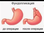 Лапароскопическая фундопликация: шаг к комфорту пищеварения Лапароскопическая фундопликация: шаг к комфорту пищеварения