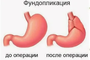 Лапароскопическая фундопликация: шаг к комфорту пищеварения Лапароскопическая фундопликация: шаг к комфорту пищеварения