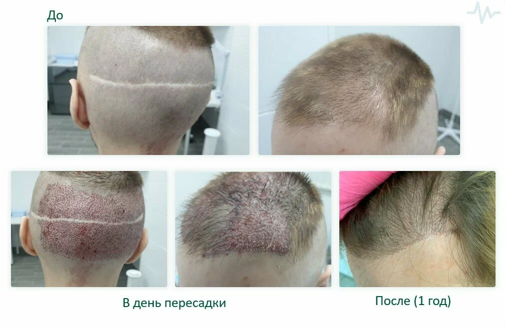 Процесс заживления после пересадки