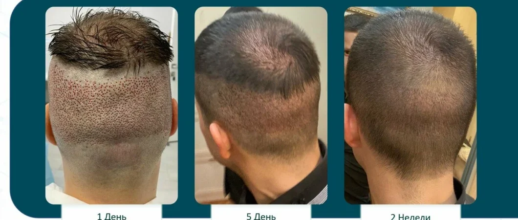 Трансплантация волос в Москве 2026: полный гид по методам и рынку