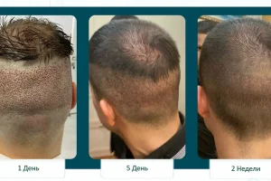 Трансплантация волос в Москве 2026: полный гид по методам и рынку Трансплантация волос в Москве 2026: полный гид по методам и рынку