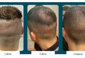 Трансплантация волос в Москве 2026: полный гид по методам и рынку