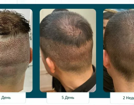 Трансплантация волос в Москве 2026: полный гид по методам и рынку